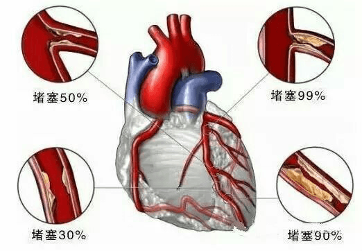 负氧离子：心脑血管疾病的调理专家